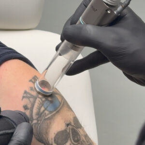 Ink-Out-with-laser-chania-2