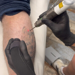 Ink-Out-with-laser-chania-3