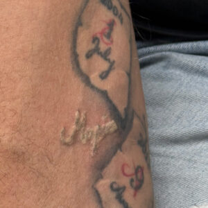 Tattoo-Removal-by-fotona-pico-laser